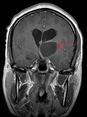 Thalamic glioma on an MRI scan